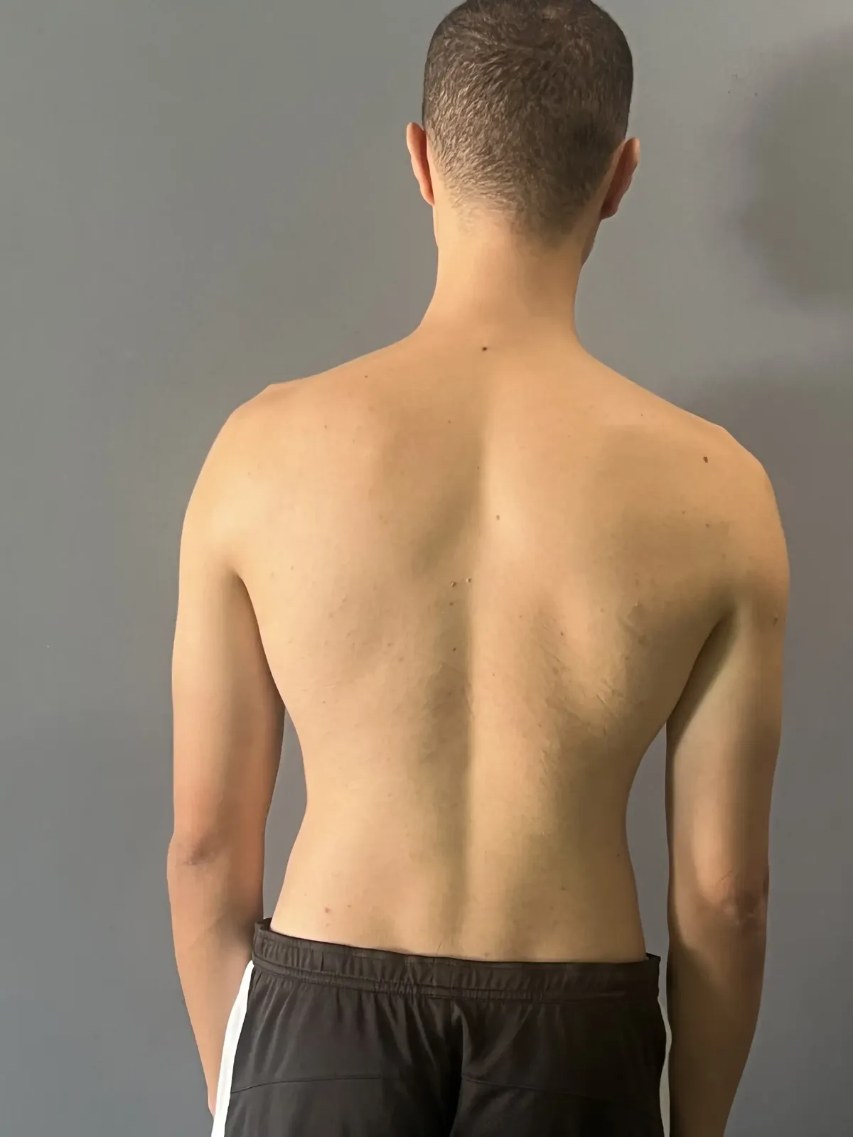 Patient 2 — avant les séances de kinésithérapie à Salé